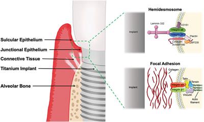 The burden of diabetes on the soft tissue seal surrounding the dental implants